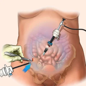 Diagnostic Laparoscopy Doctors in Rajendra Nagar