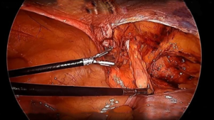 Best Laparoscopic Inguinal Hernia Repair in Rajendra Nagar