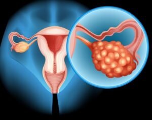 Best Doctor for Ovarian Cyst Treatment in Indirapuram