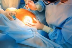 Best Gallbladder Surgery in Rajinder Nagar