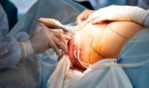 Best Hysterectomy Surgeon in Indirapuram