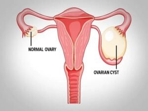 Best Ovarian Cyst Doctor in Indirapuram