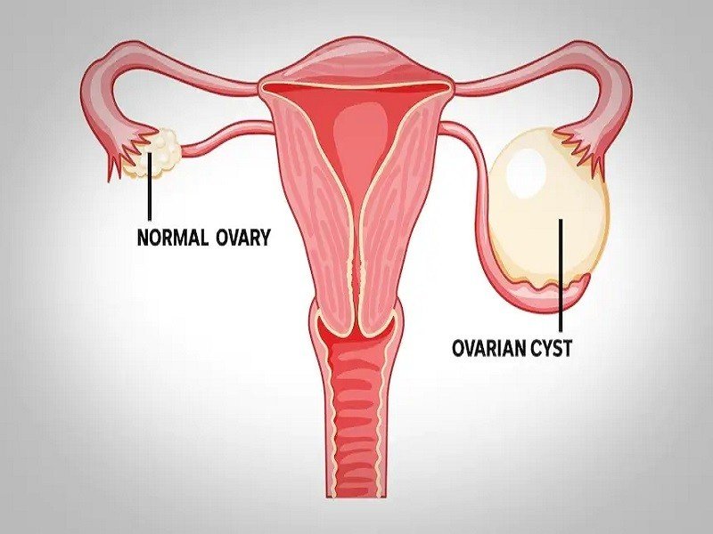 Best Ovarian Cyst Doctor in Indirapuram