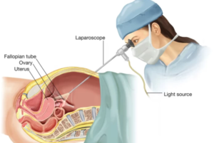 Best Diagnostic Laparoscopy Treatment in Kaushambi